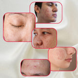 Perfect Trifecta Acne Peel | Korean Skin Care for All Skin Types