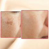 Before and after. Targeting hyperpigmentation with Gymsegbe Eraser Spot Cream