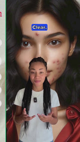 Gymsegbe Acne Set full skincare routine for acne-prone skin