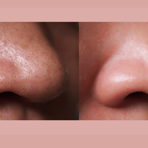 before and after blackheads