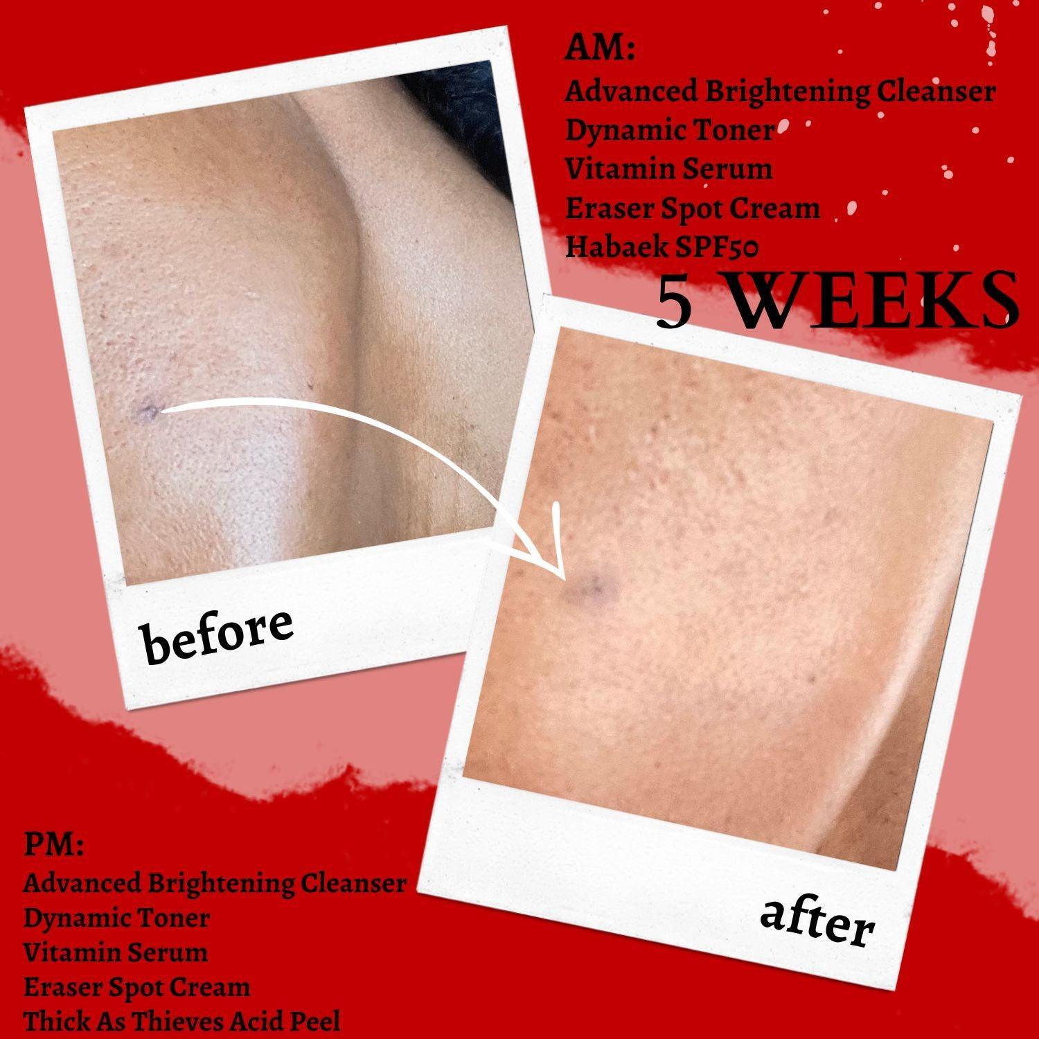 before and after applying vitamin erum five weeks