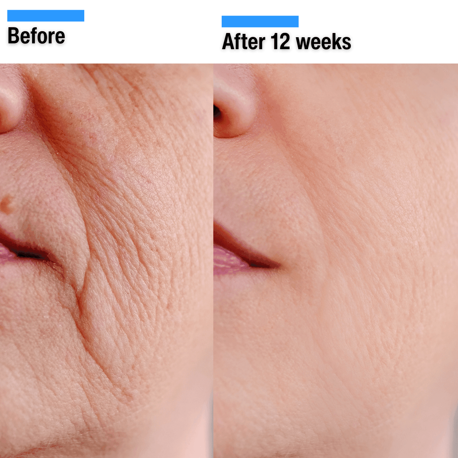 Before and after comparison of skin texture on a person's face, showing reduced wrinkles.